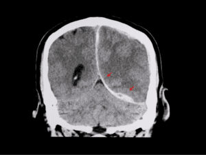 Brain X-ray