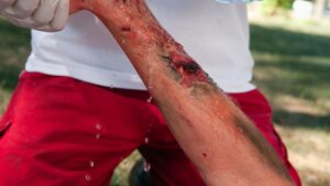 Michigan Burn Injury Lawyer