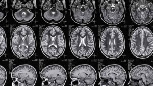 Troy Brain Injury Lawyer