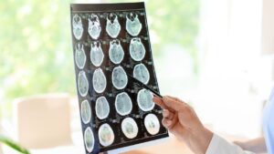 Michigan Brain Injury Attorney