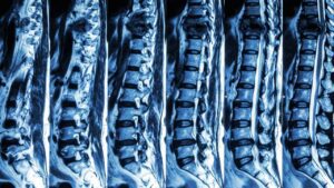 Kalamazoo Spinal Cord Injury Attorney